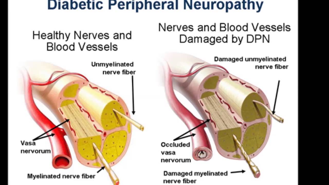 diabetic-peripheral-neuropathy-clinical-trials