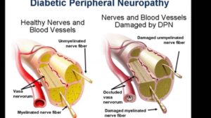 Gabapentin for Diabetic Peripheral Neuropathy