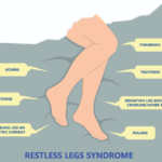 Restless Legs Syndrome Fact Sheet