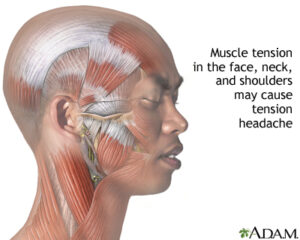 What is a Tension Headache and The Causes of Tension Headache