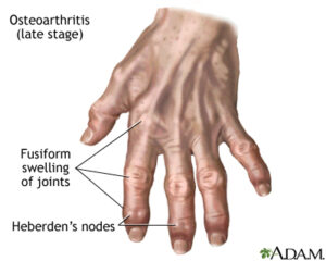 Osteoarthritis Treatment and Home Remedies For Osteoarthritis