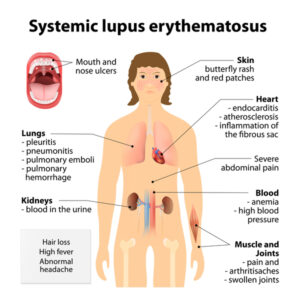 Lupus