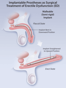 How is Erectile Dysfunction Treated?  Surgical and Non-surgical Treatments for Erectile Dysfunction